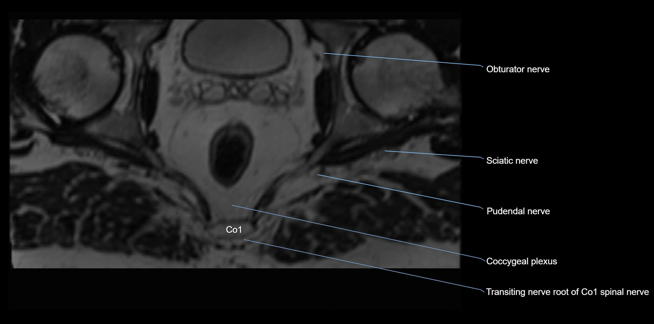 MR lumbosacral plexus axial cross sectional anatomy 3T  radiology  image-img-1008001-00123.webp
